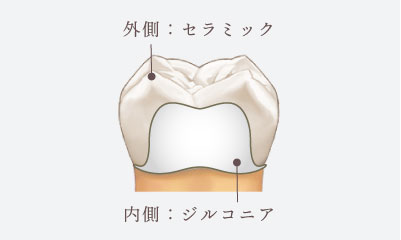 外側がセラミック、内側がジルコニア