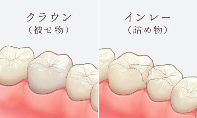 クラウン（被せ物）・インレー（詰め物）