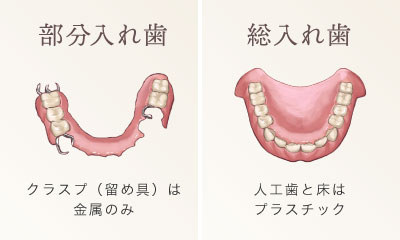 部分入れ歯…クラスプ（留め具）は金属のみ　総入れ歯…人工歯と床はプラスチック