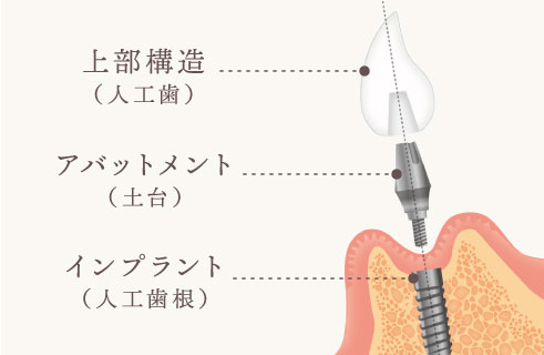 上部構造（人工歯）、アバットメント（土台）、インプラント（人工歯根）