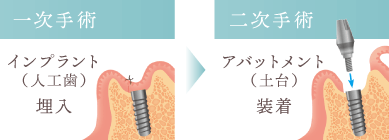 ＜一次手術＞インプラント（人工歯根）埋入　→　＜二次手術＞アバットメント（土台）装着