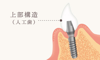 上部構造（人工歯）